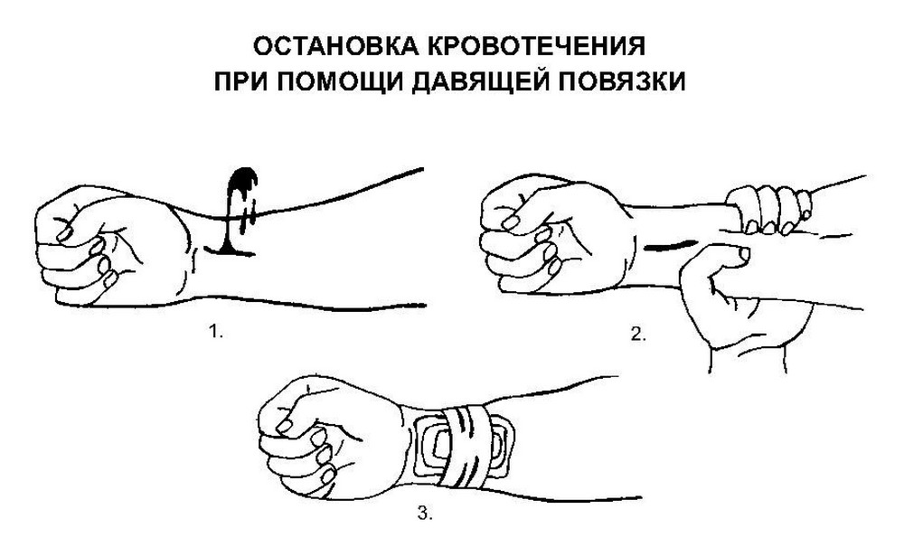 При венозном кровотечении накладывается давящая повязка. Давящая повязка метод остановки кровотечения. Давящая повязка для остановки венозного кровотечения.